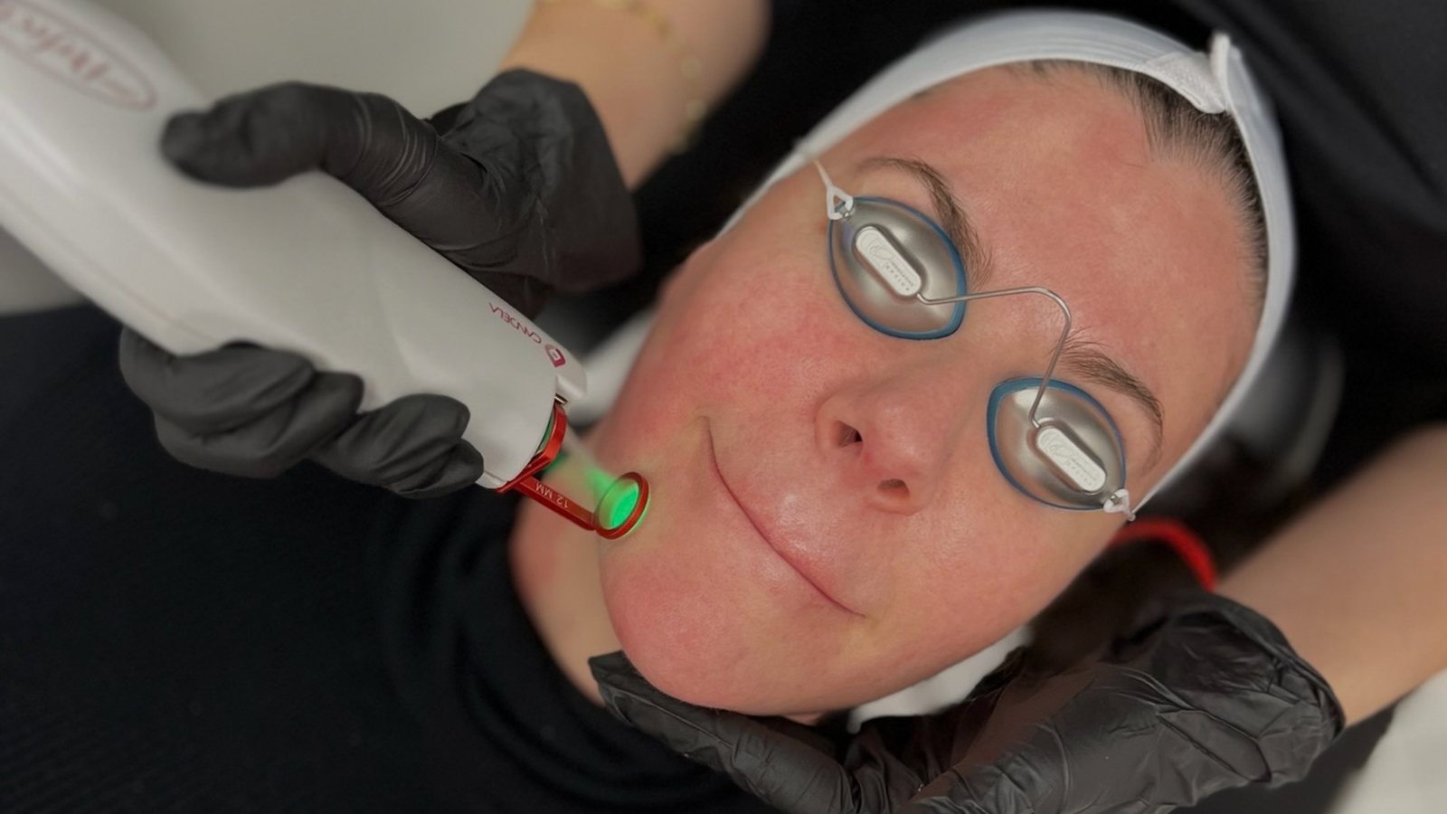 Laser VBeam : cicatrices rouges, rosacée et taches de vin